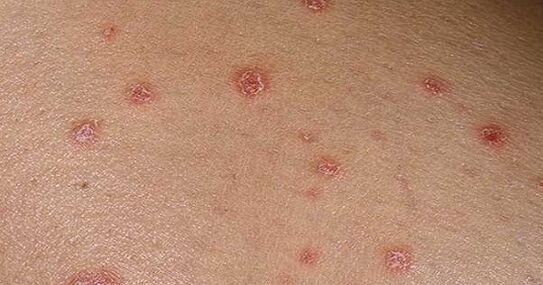 Ploques psoriatikoak