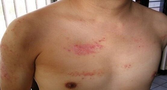 Psoriasia bularreko eremuan