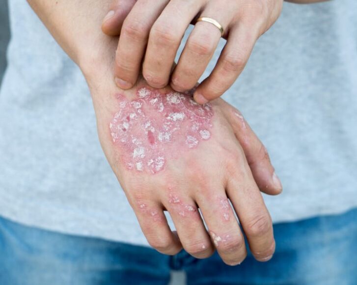 Psoriasia eskuetan