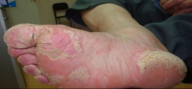 Psoriasia hanketan