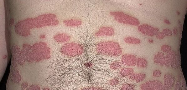 Psoriasia