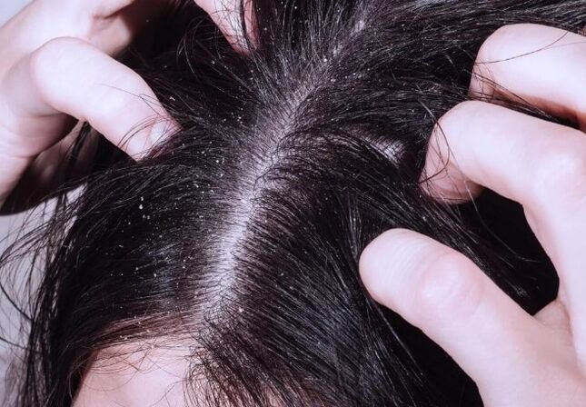 Psoriasia buruan