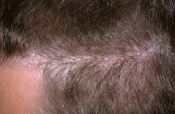 Psoriasia buruan
