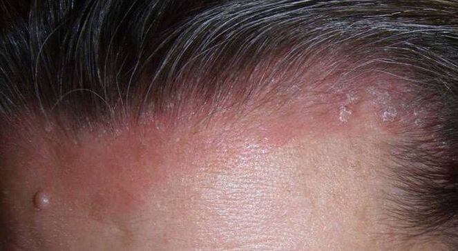 Zer da psoriasia
