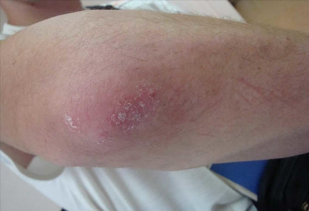 Psoriasia nolakoa den