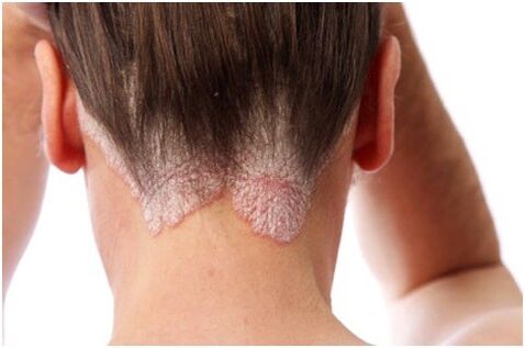 Psoriasia ilean