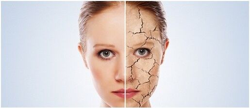 Psoriasia tratatzen dugu
