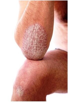 Psoriasia ukondoan