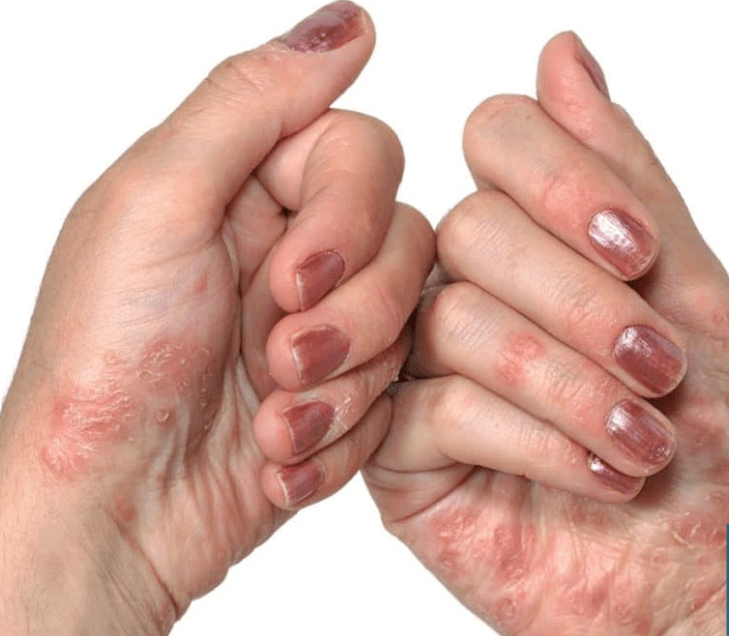 Psoriasia eskuetan