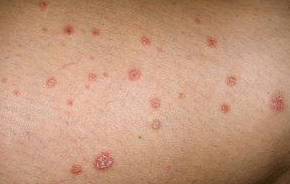 Ploques psoriatikoak