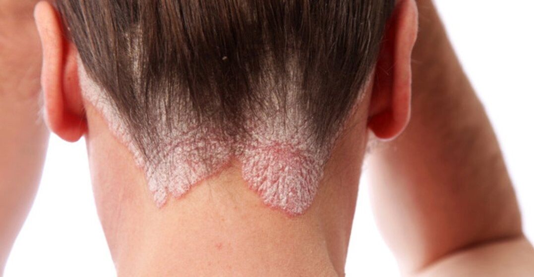 Psoriasia nesken buruan