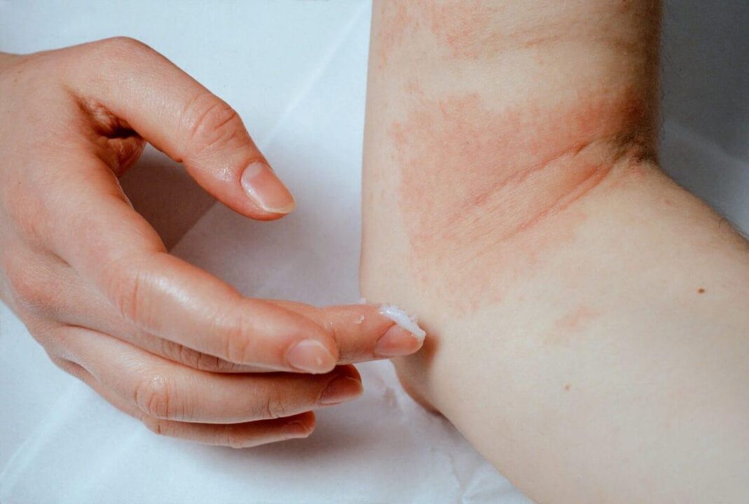 Psoriasiaren tratamendua