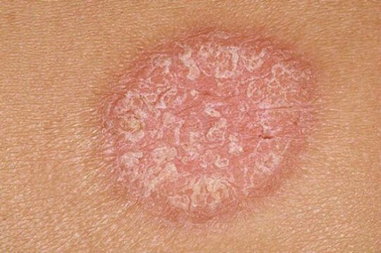psoriasia