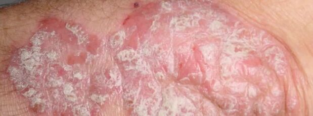 Psoriasia meesnichered