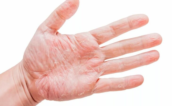 Psoriasia