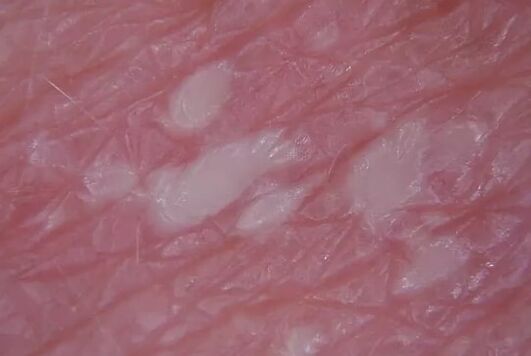 Pustulenia psoriasia