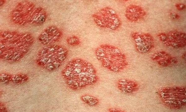 Psoriasia moduak