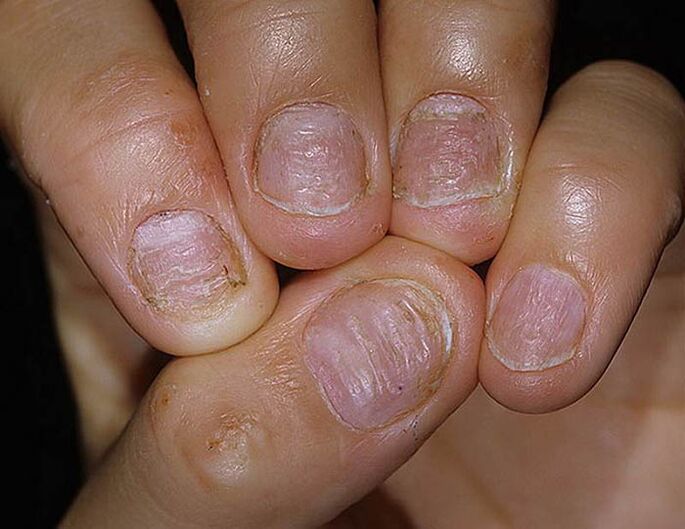 Iltzeen psoriasia