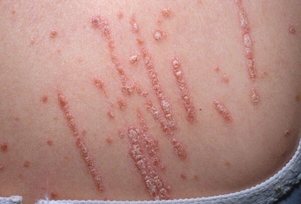 Psoriasia gorputzean