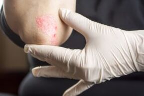 Psoriasia ukondoan