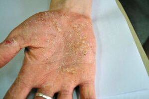 Psoriasia zure eskuko palman