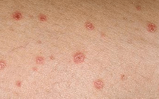 Psoriasia hasierako fasean
