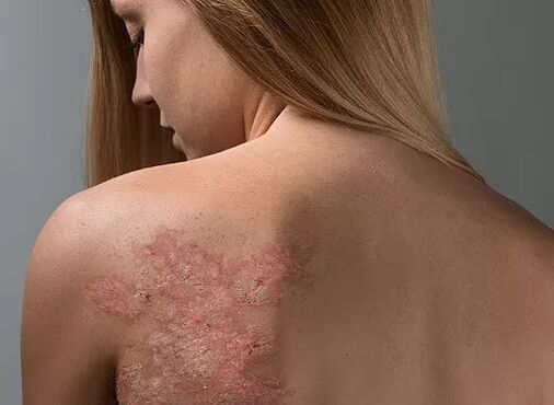 Psoriasia neska baten bizkarrean