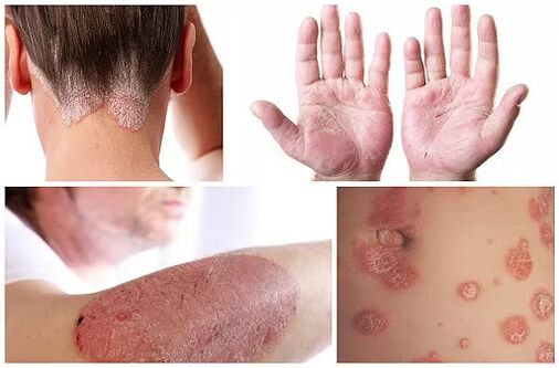 Psoriasiaren adierazpenak gorputzeko atal ezberdinetan