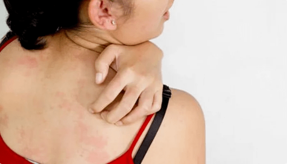 psoriasia