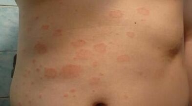 nola psoriasiaren hasierako fasea ezagutu