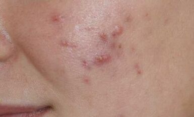 psoriasiaren hasierako fasearen sintomak