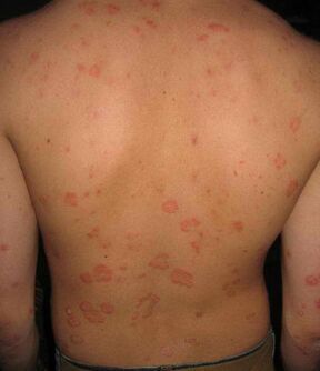 psoriasia bizkarrean