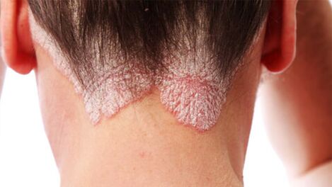 Psoriatiko plakak azalean