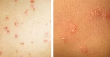 psoriasiaren adierazpen nagusiak