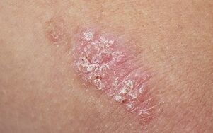 psoriasiaren arrazoiak