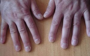psoriasiaren sintomak hasierako fasean