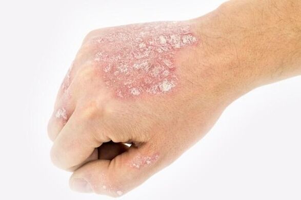 Eskuetan psoriasia garatzeko mekanismoa