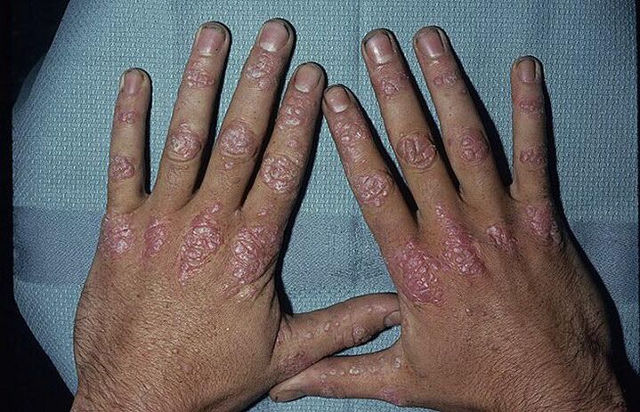 psoriasia eskuetan garatzeko arrazoiak