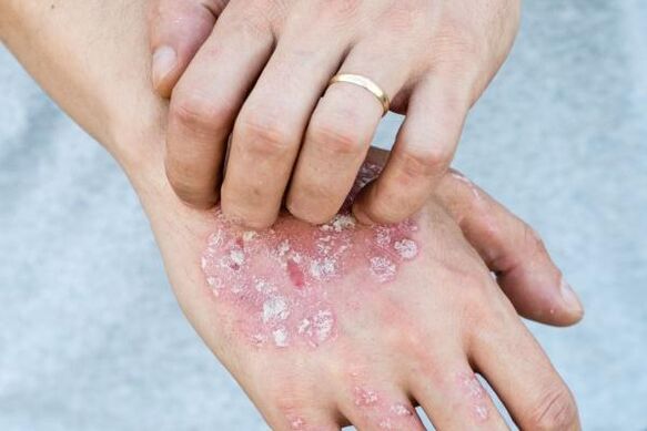 psoriasiaren sintomak eskuetan