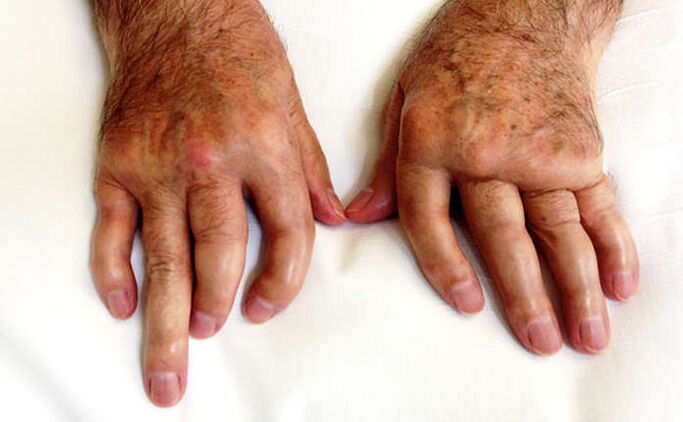Psoriasia artritisa mutilatzea